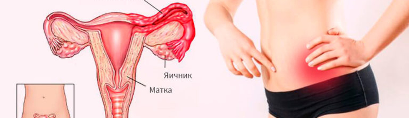 Воспаление яичников