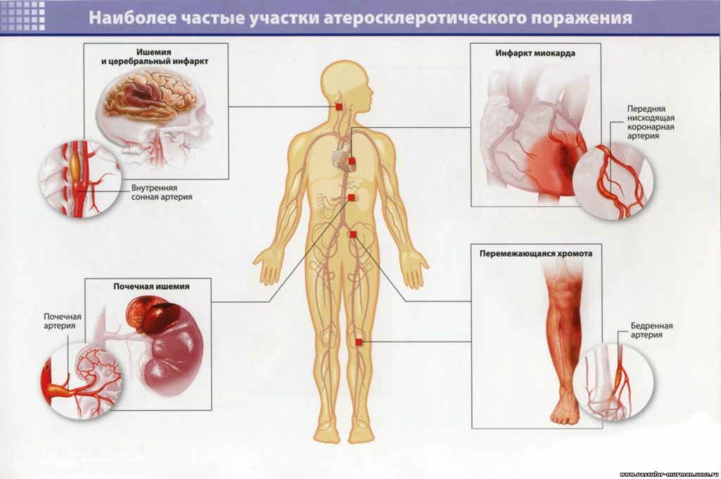 Атеросклероз артерий