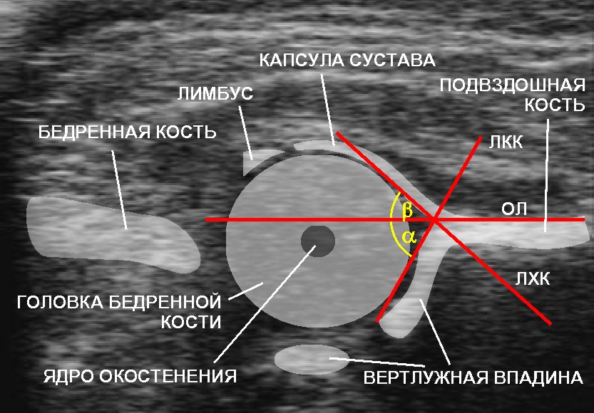УЗИ тазобедренных суставов у новорожденных