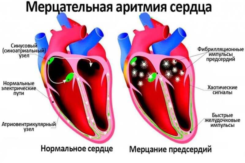 Аритмия сердца причины