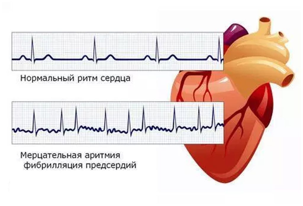 Мерцательная аритмия сердца