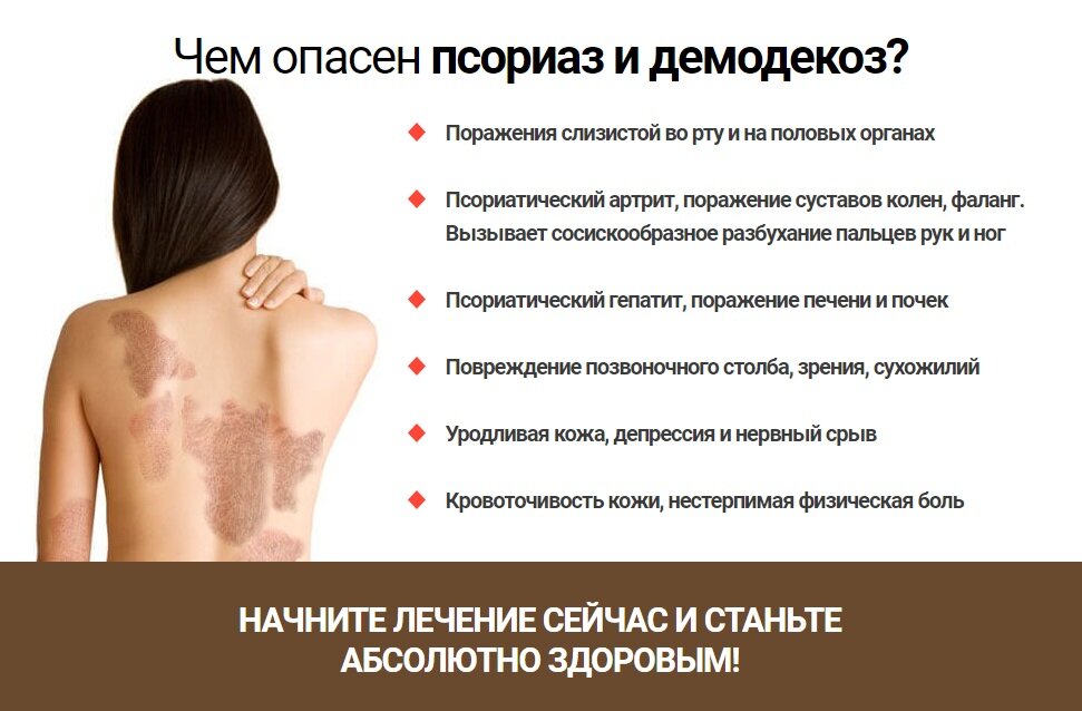 Псориаз эффективное лечение