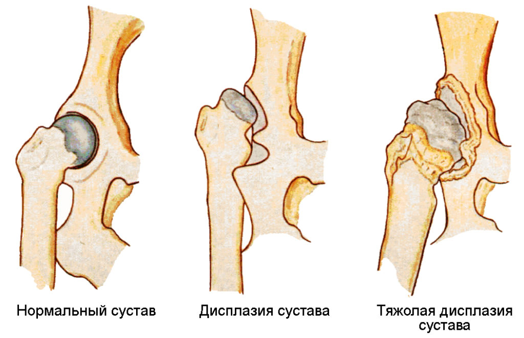 Дисплазия тазобедренных суставов