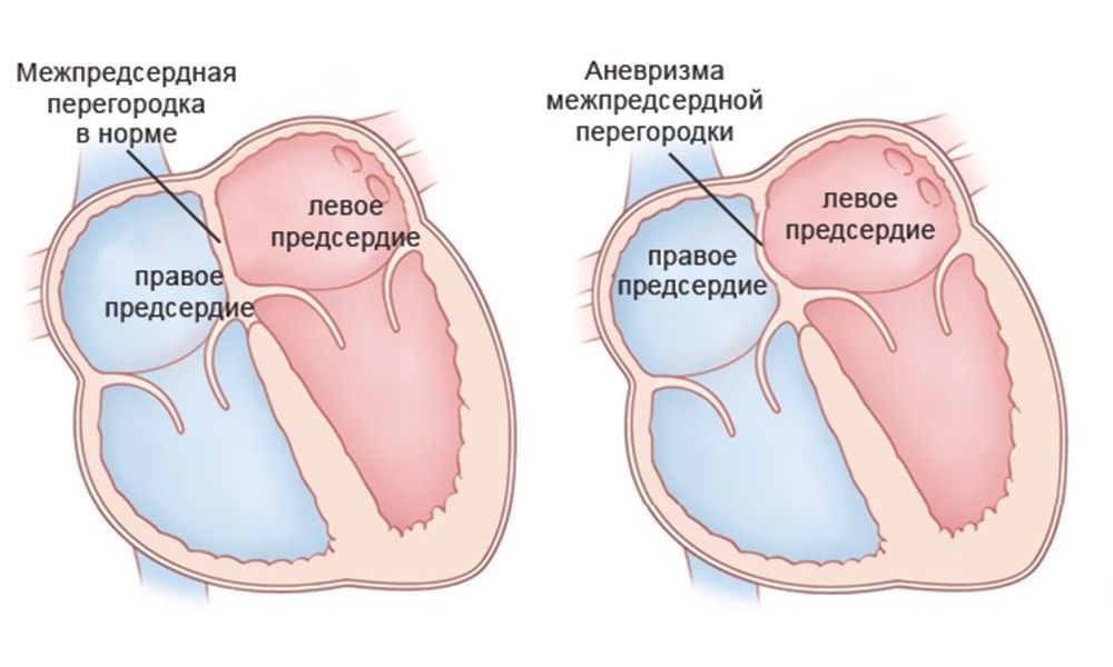 Аневризма сердца, лечение