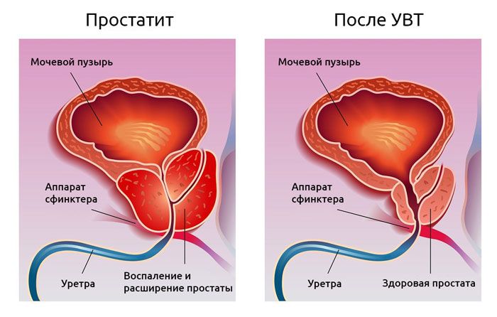 УВТ предстательной железы