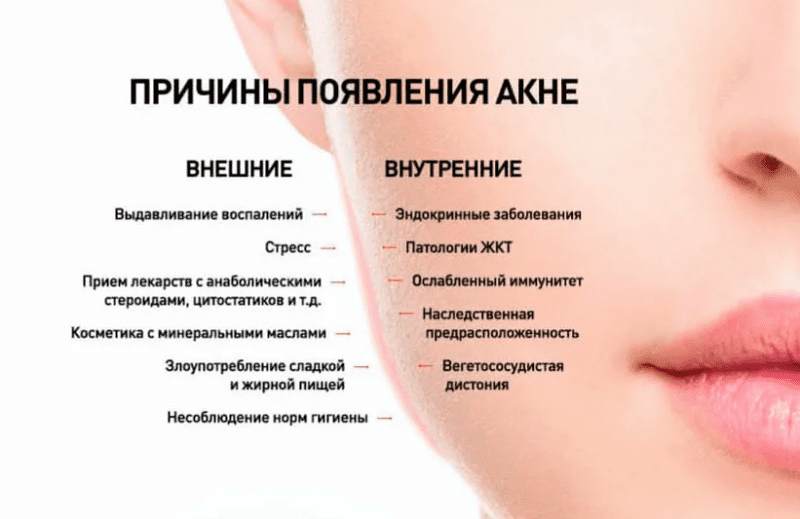 Лечение акне на лице