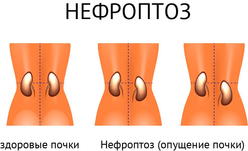 Нефроптоз симптомы