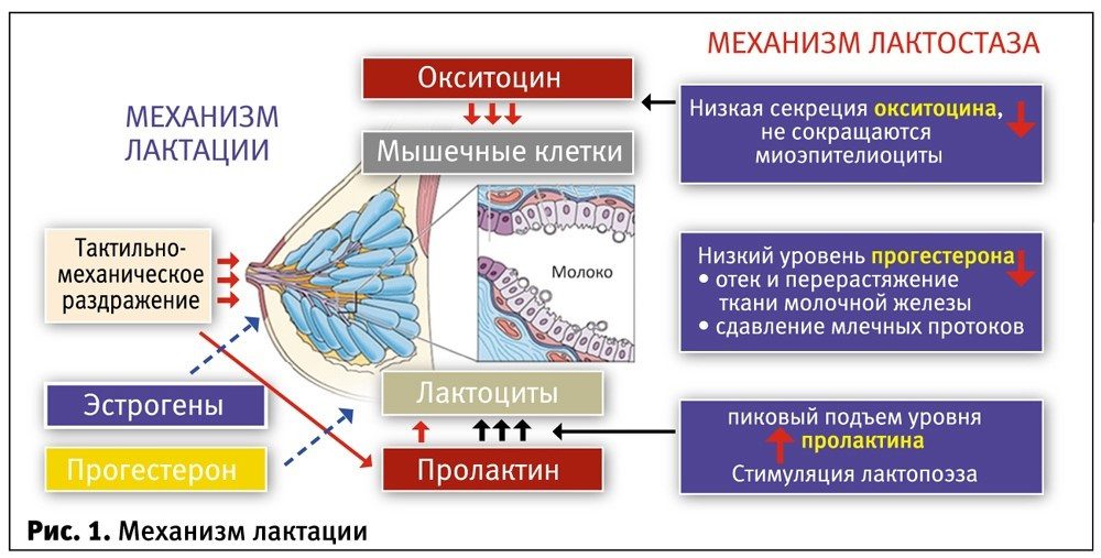 Лактостаз врач