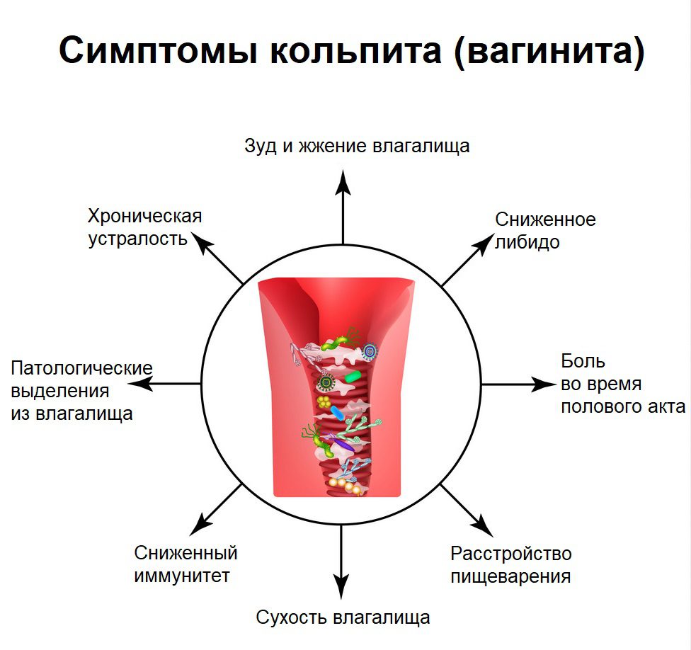 Симптомы кольпита женщин