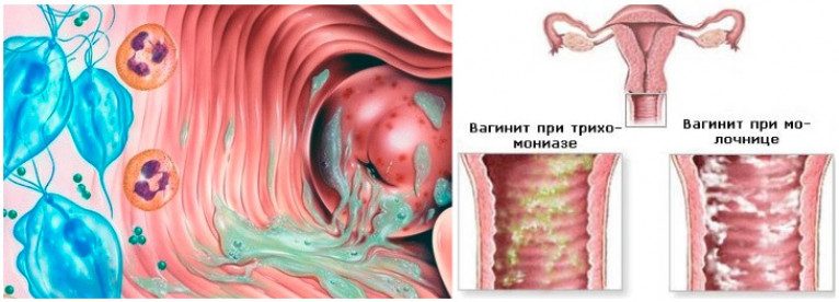 Кольпит лечение у женщин