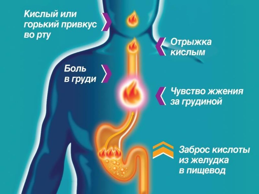 Как убрать изжогу