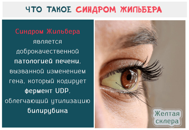 Анализ на синдром Жильбера