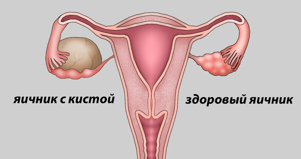 Как лечить кисту яичника