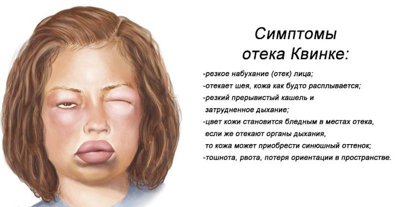 Отек Квинке симптомы