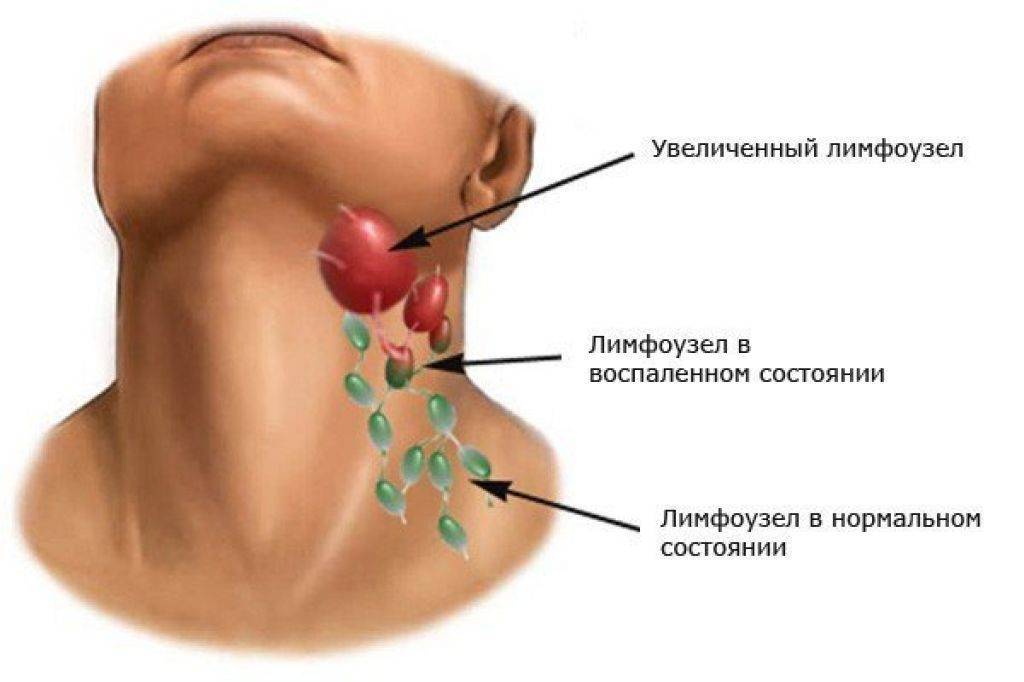 УЗИ шейных лимфоузлов