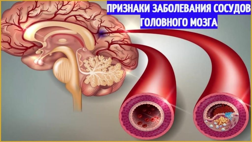 Заболевание сосудов головного мозга симптомы