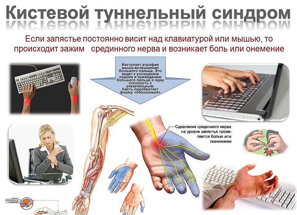 Туннельный синдром симптомы