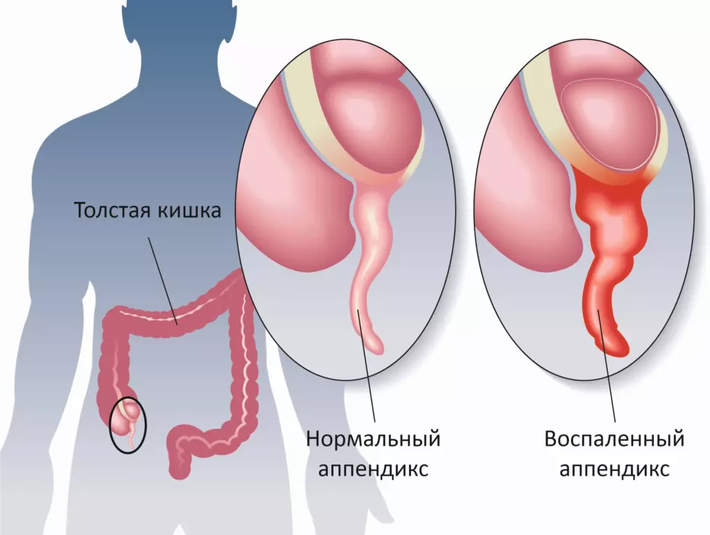 Операция на аппендицит