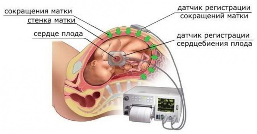 КТГ при беременности ростов