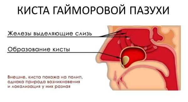 Киста гайморовой пазухи
