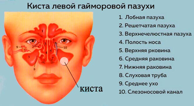 Киста пазухи