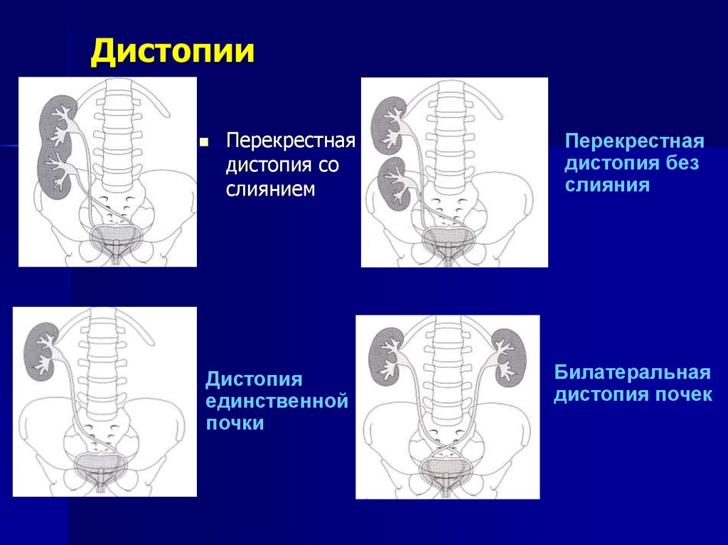 Аномалии развития почек