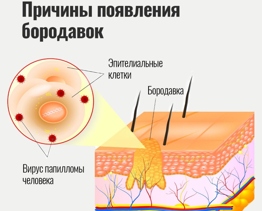 Подошвенная бородавка4