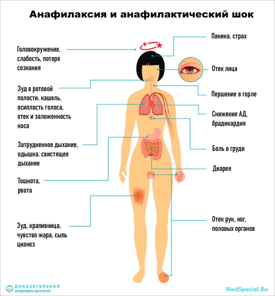 Анафилактический шок - симптомы