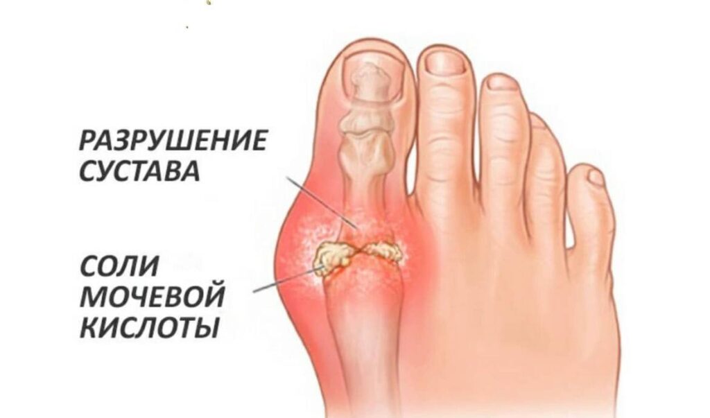 Подагра: причины, симптомы, лечение